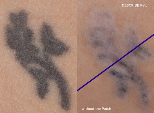 After photo of tattoo removal using Describe Patch