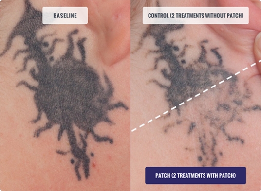 Before and after photo of laser tattoo removal dallas using Patch
