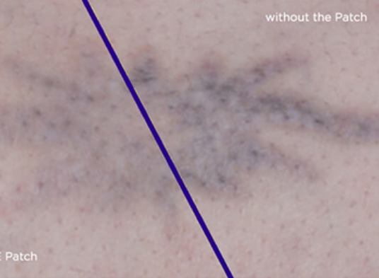 Tattoo removal service in Dallas using Patch