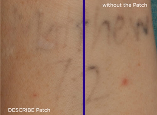 Laser tattoo removal plus using describe Patch